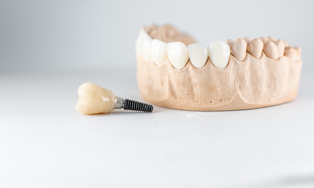 Dental Implants